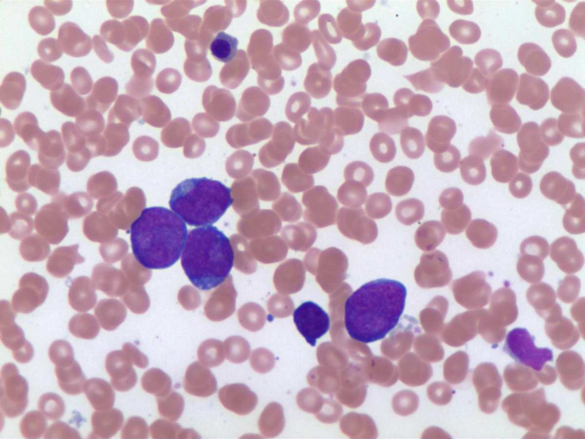 Blasts in bone marrow aspirate 60x